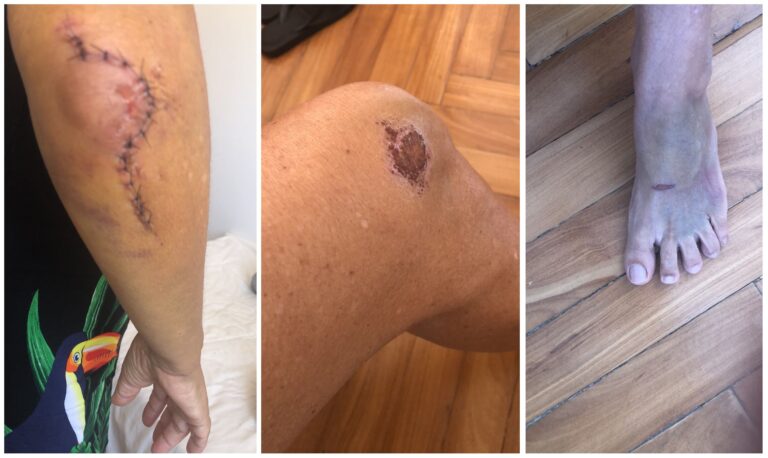 Aposentada atropelada por patinete na contramão teve despesa de R$ 13 mil; g1 flagra irregularidades, que não têm punição | Rio de Janeiro